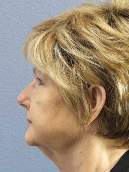 Facelift Before & After Patient #11640
