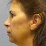 Facelift Before & After Patient #7557