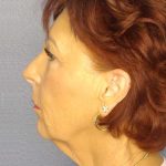 Facelift Before & After Patient #11714