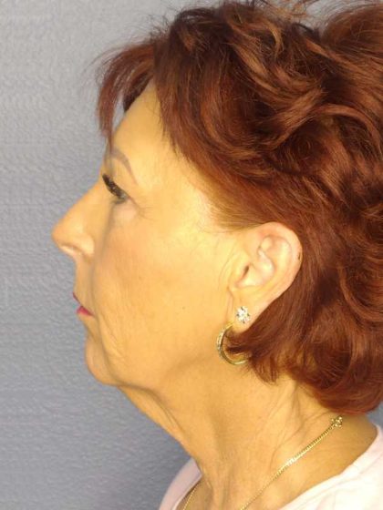 Facelift Before & After Patient #11714