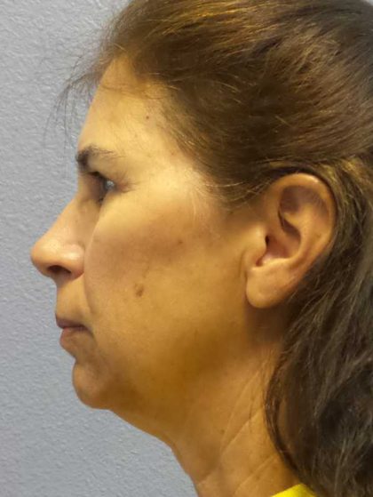 Facelift Before & After Patient #7557