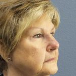 Facelift Before & After Patient #11640