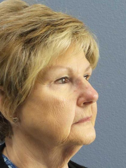 Facelift Before & After Patient #11640