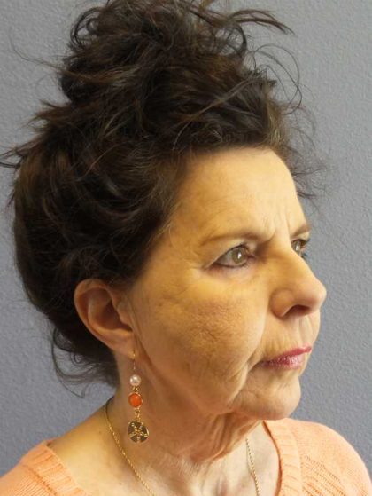Facelift Before & After Patient #7514
