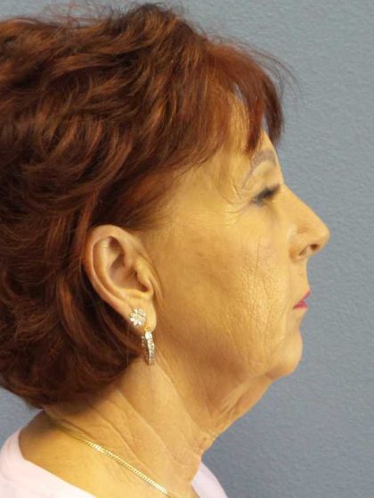 Facelift Before & After Patient #11714