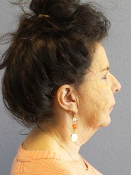 Facelift Before & After Patient #7514