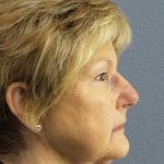 Facelift Before & After Patient #11640