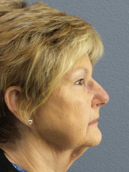 Facelift Before & After Patient #11640