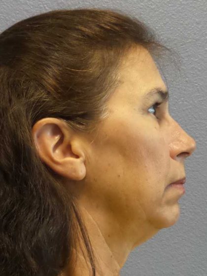 Facelift Before & After Patient #7557