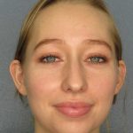 Rhinoplasty Before & After Patient #9761