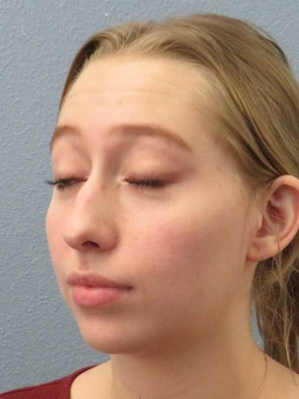 Rhinoplasty Before & After Patient #9761