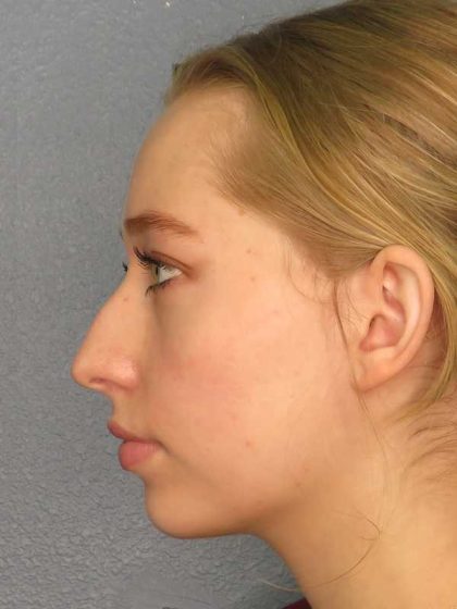 Rhinoplasty Before & After Patient #9761