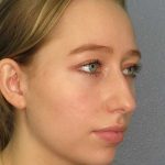 Rhinoplasty Before & After Patient #9761