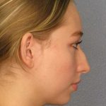 Rhinoplasty Before & After Patient #9761