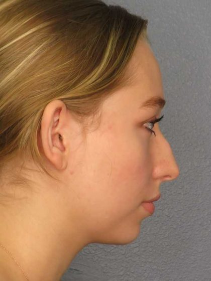 Rhinoplasty Before & After Patient #9761