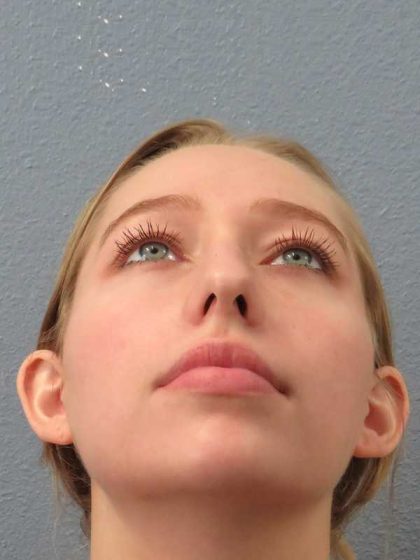 Rhinoplasty Before & After Patient #9761