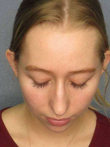 Rhinoplasty Before & After Patient #9761