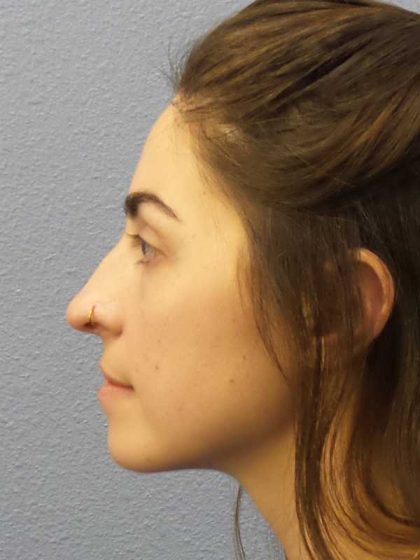 Rhinoplasty Before & After Patient #12351