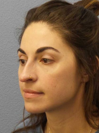 Rhinoplasty Before & After Patient #12351