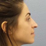 Rhinoplasty Before & After Patient #12351