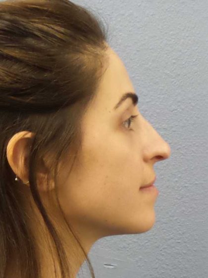 Rhinoplasty Before & After Patient #12351