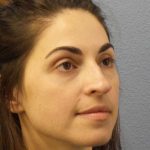 Rhinoplasty Before & After Patient #12351