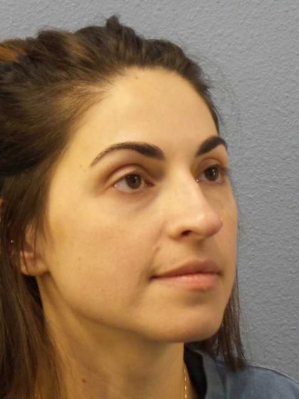 Rhinoplasty Before & After Patient #12351