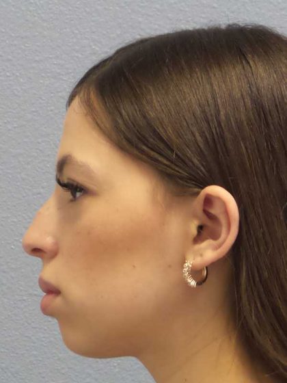 Rhinoplasty Before & After Patient #12395