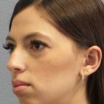 Rhinoplasty Before & After Patient #12395