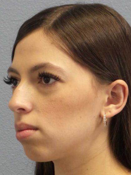 Rhinoplasty Before & After Patient #12395