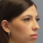 Rhinoplasty Before & After Patient #12395