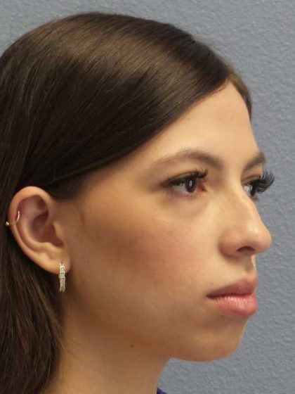 Rhinoplasty Before & After Patient #12395