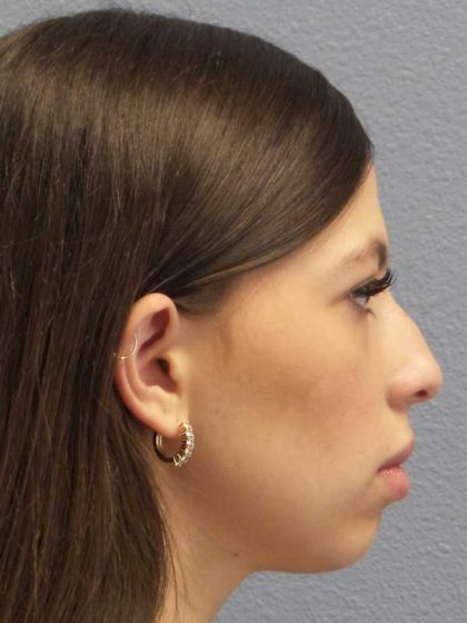 Rhinoplasty Before & After Patient #12395