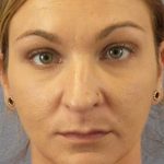 Rhinoplasty Before & After Patient #11029