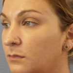 Rhinoplasty Before & After Patient #11029