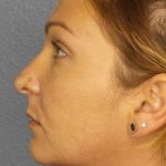 Rhinoplasty Before & After Patient #11029