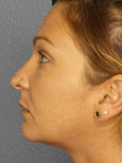 Rhinoplasty Before & After Patient #11029