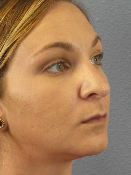 Rhinoplasty Before & After Patient #11029