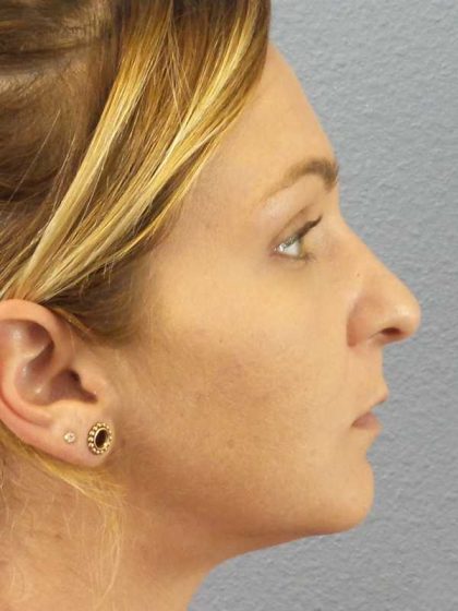Rhinoplasty Before & After Patient #11029
