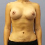 Breast Augmentation Before & After Patient #5248
