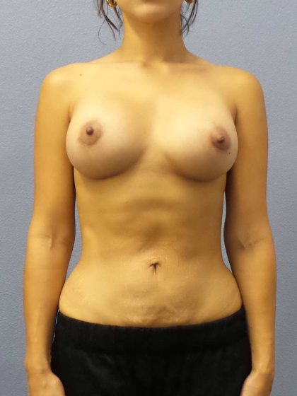 Breast Augmentation Before & After Patient #5248