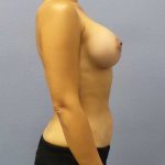 Breast Augmentation Before & After Patient #5248