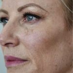 Halo Laser Treatments Before & After Patient #13210