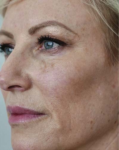 Halo Laser Treatments Before & After Patient #13210
