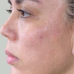 Halo Laser Treatments Before & After Patient #13211