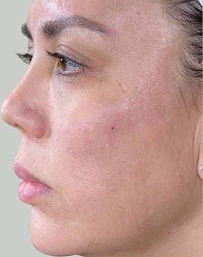 Halo Laser Treatments Before & After Patient #13211