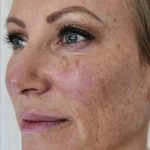 Halo Laser Treatments Before & After Patient #13210