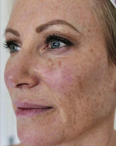 Halo Laser Treatments Before & After Patient #13210