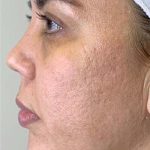 Halo Laser Treatments Before & After Patient #13211