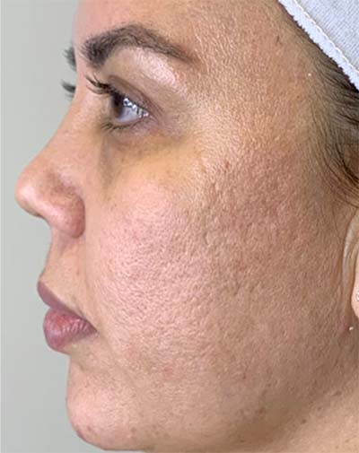 Halo Laser Treatments Before & After Patient #13211